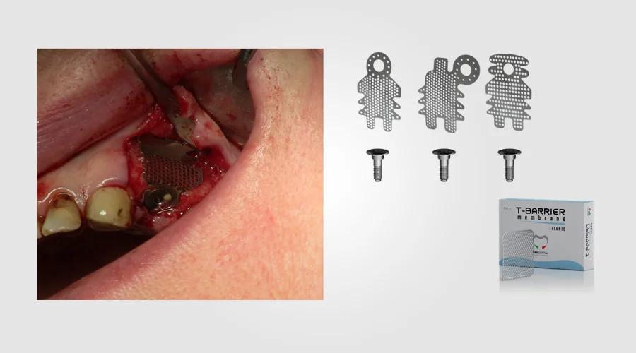 Titanium Membrane 2 - Marks Biotech