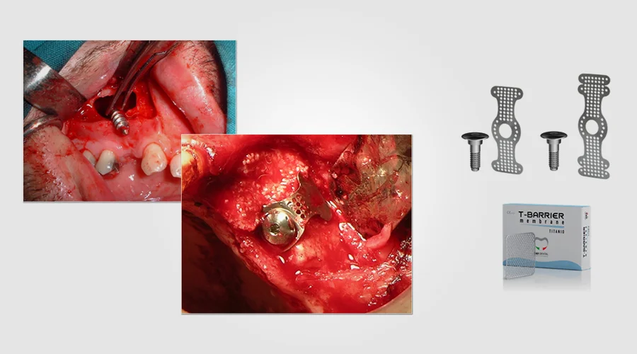 Titanium Membrane 4 - Marks Biotech