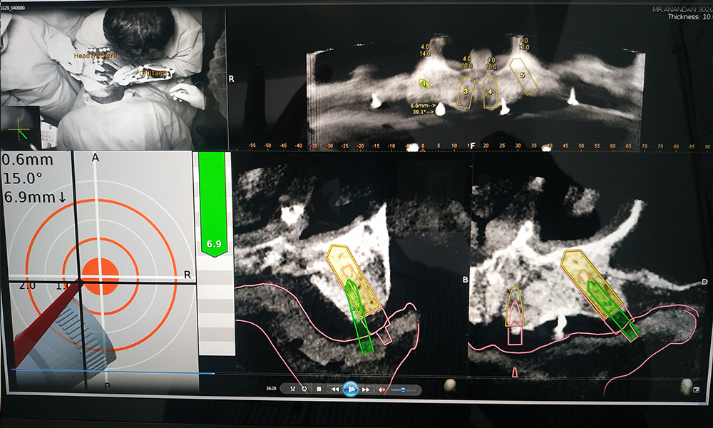 Full Mouth Rehabilitation Cases done with Navident 3.0 - March 29th, 2021