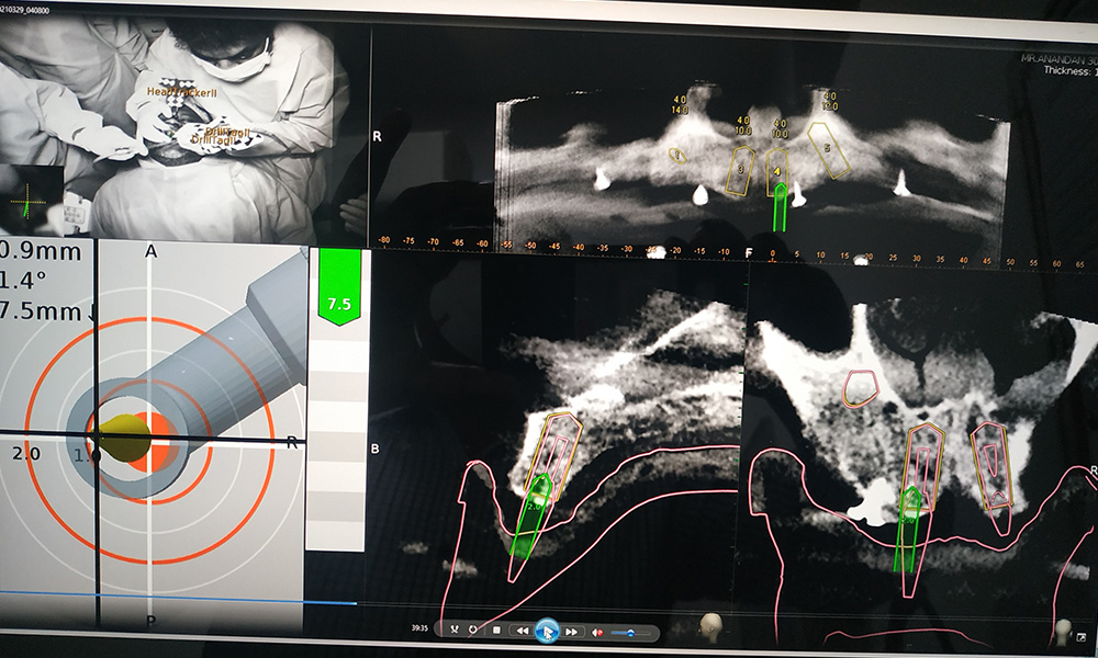 Full Mouth Rehabilitation Cases done with Navident 3.0 - March 29th, 2021