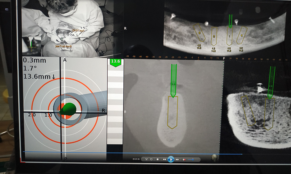 Full Mouth Rehabilitation Cases done with Navident 3.0 - March 29th, 2021