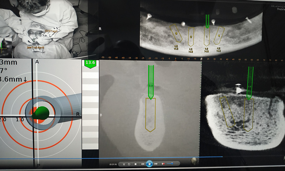 Full Mouth Rehabilitation Cases done with Navident 3.0 - March 29th, 2021