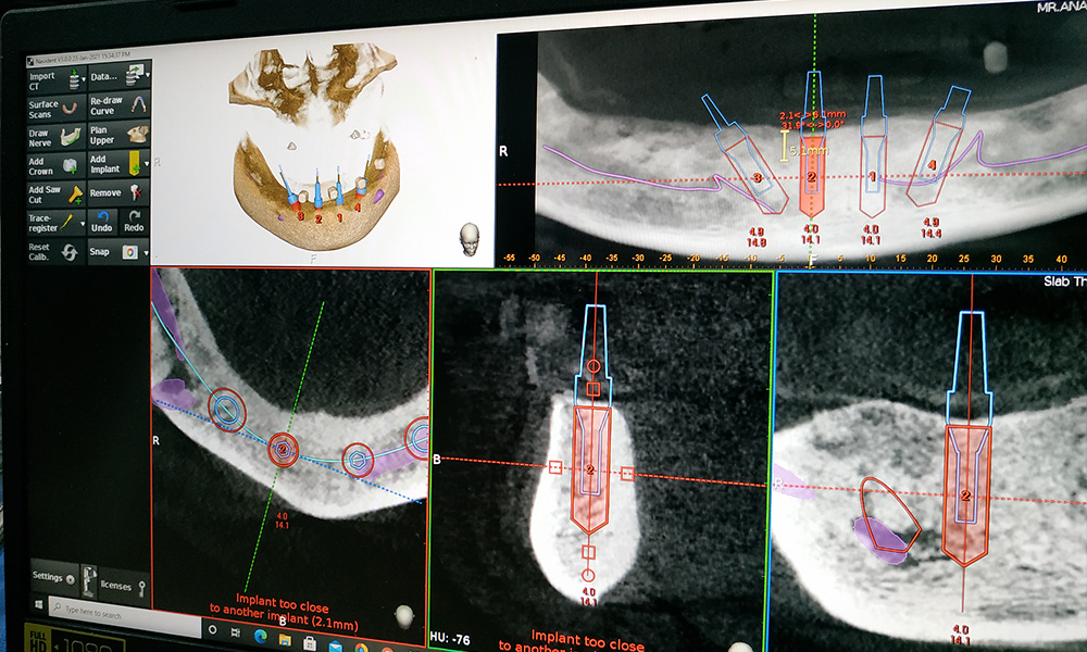 Full Mouth Rehabilitation Cases done with Navident 3.0 - March 29th, 2021